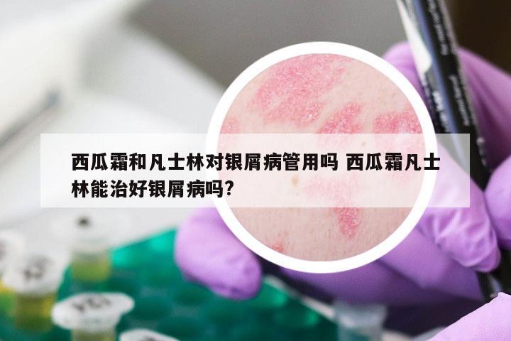 西瓜霜和凡士林对银屑病管用吗 西瓜霜凡士林能治好银屑病吗?