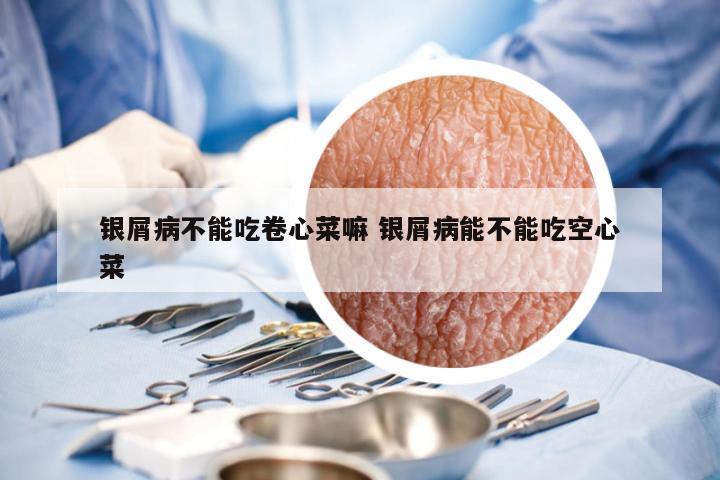 银屑病不能吃卷心菜嘛 银屑病能不能吃空心菜