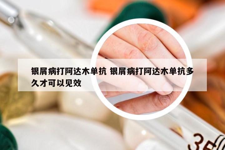 银屑病打阿达木单抗 银屑病打阿达木单抗多久才可以见效