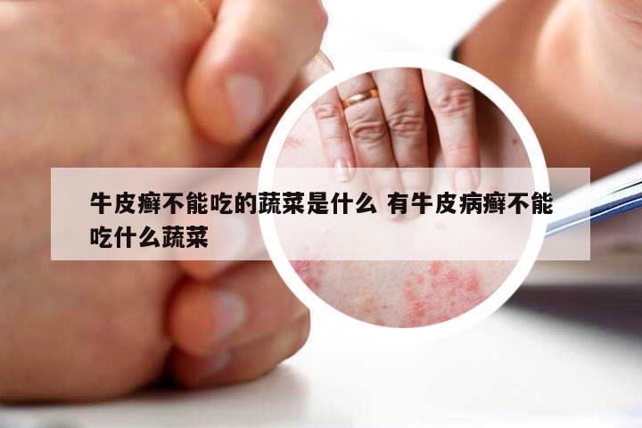 牛皮癣不能吃的蔬菜是什么 有牛皮病癣不能吃什么蔬菜