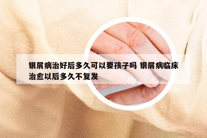 银屑病治好后多久可以要孩子吗 银屑病临床治愈以后多久不复发