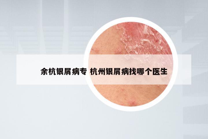 余杭银屑病专 杭州银屑病找哪个医生