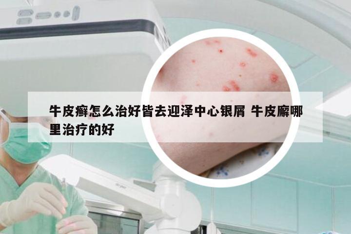 牛皮癣怎么治好皆去迎泽中心银屑 牛皮廨哪里治疗的好