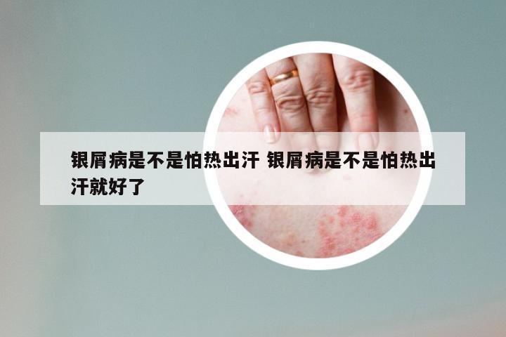 银屑病是不是怕热出汗 银屑病是不是怕热出汗就好了