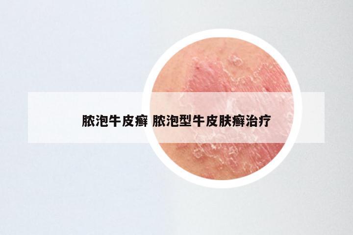 脓泡牛皮癣 脓泡型牛皮肤癣治疗