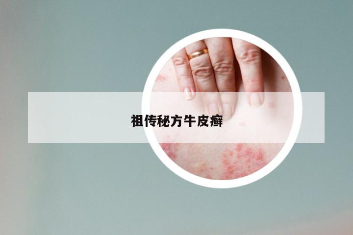 祖传秘方牛皮癣