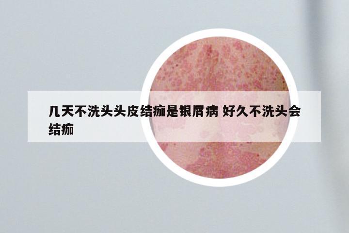 几天不洗头头皮结痂是银屑病 好久不洗头会结痂
