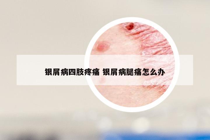 银屑病四肢疼痛 银屑病腿痛怎么办