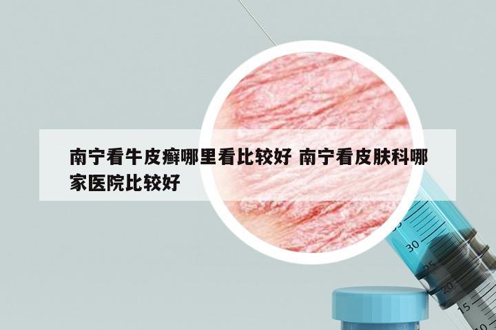 南宁看牛皮癣哪里看比较好 南宁看皮肤科哪家医院比较好