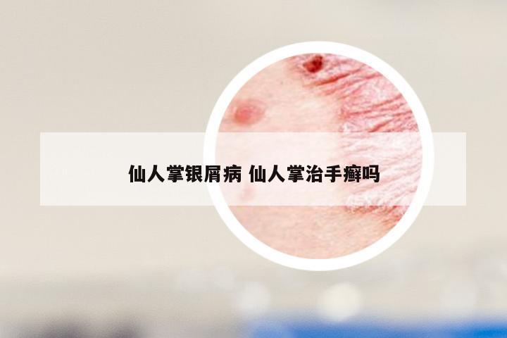 仙人掌银屑病 仙人掌治手癣吗