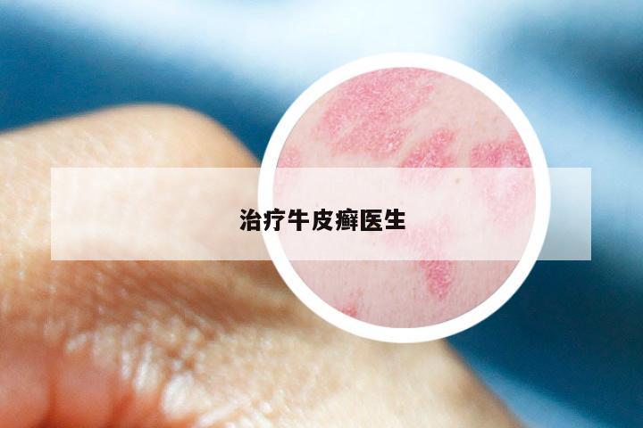 治疗牛皮癣医生