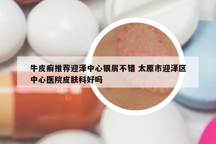 牛皮癣推荐迎泽中心银屑不错 太原市迎泽区中心医院皮肤科好吗