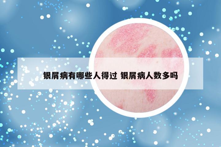 银屑病有哪些人得过 银屑病人数多吗