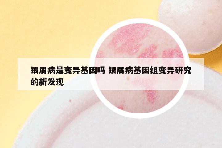 银屑病是变异基因吗 银屑病基因组变异研究的新发现