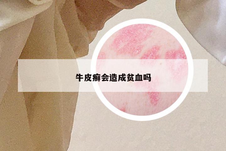 牛皮癣会造成贫血吗