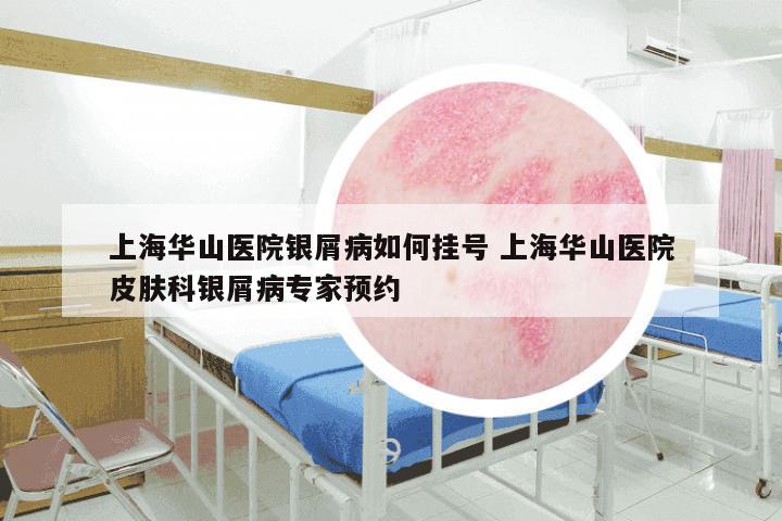 上海华山医院银屑病如何挂号 上海华山医院皮肤科银屑病专家预约