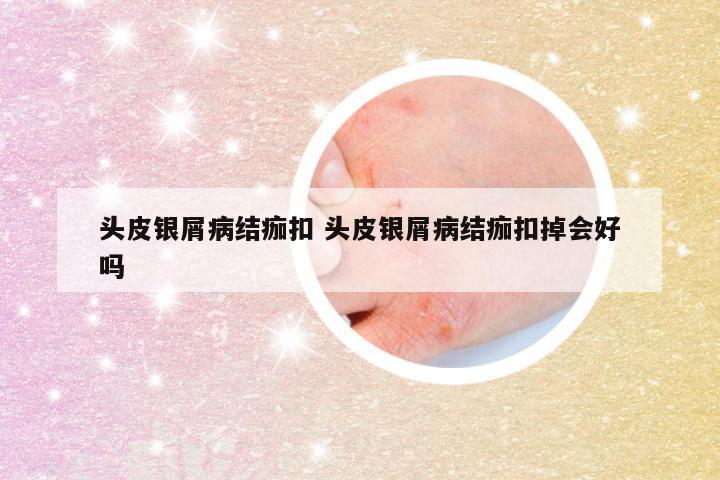 头皮银屑病结痂扣 头皮银屑病结痂扣掉会好吗