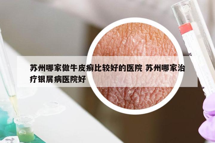 苏州哪家做牛皮癣比较好的医院 苏州哪家治疗银屑病医院好