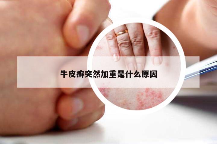 牛皮癣突然加重是什么原因