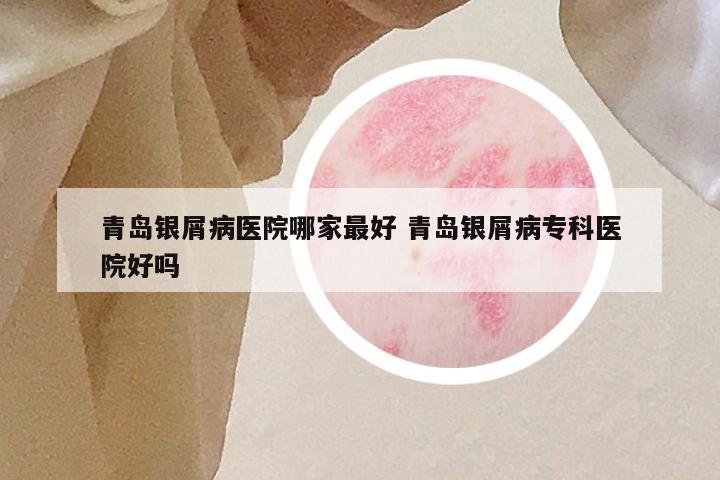 青岛银屑病医院哪家最好 青岛银屑病专科医院好吗