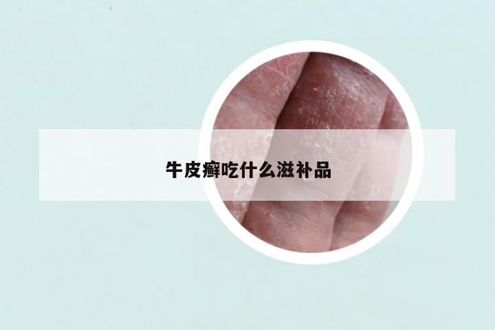 牛皮癣吃什么滋补品