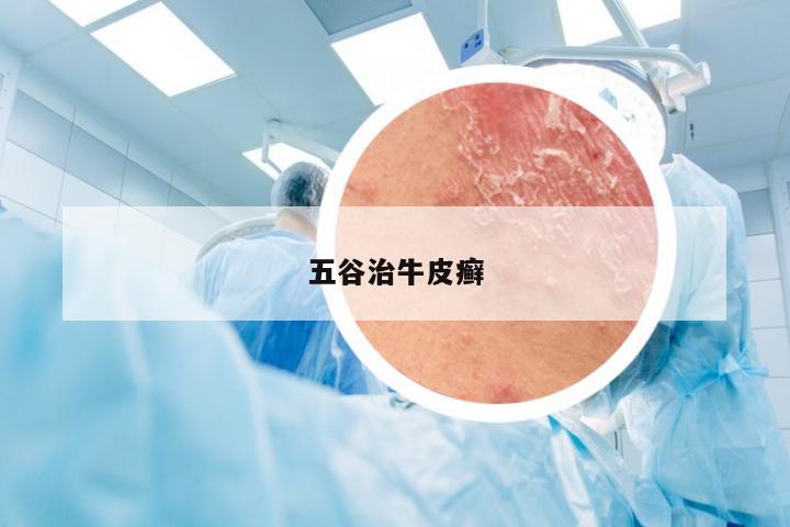 五谷治牛皮癣