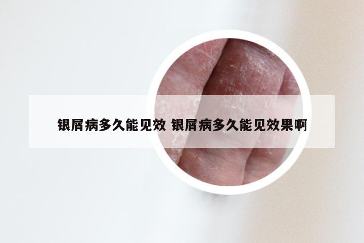 银屑病多久能见效 银屑病多久能见效果啊
