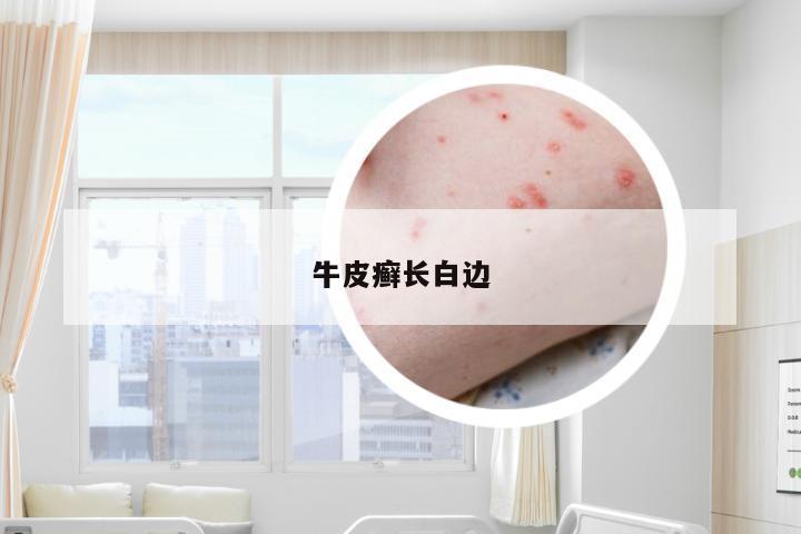 牛皮癣长白边