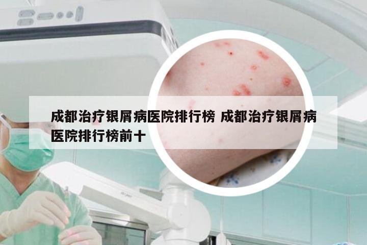 成都治疗银屑病医院排行榜 成都治疗银屑病医院排行榜前十