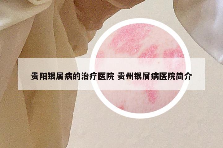 贵阳银屑病的治疗医院 贵州银屑病医院简介