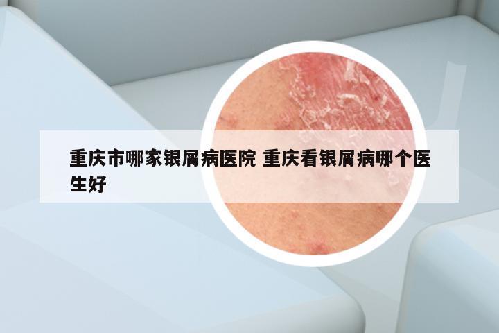 重庆市哪家银屑病医院 重庆看银屑病哪个医生好