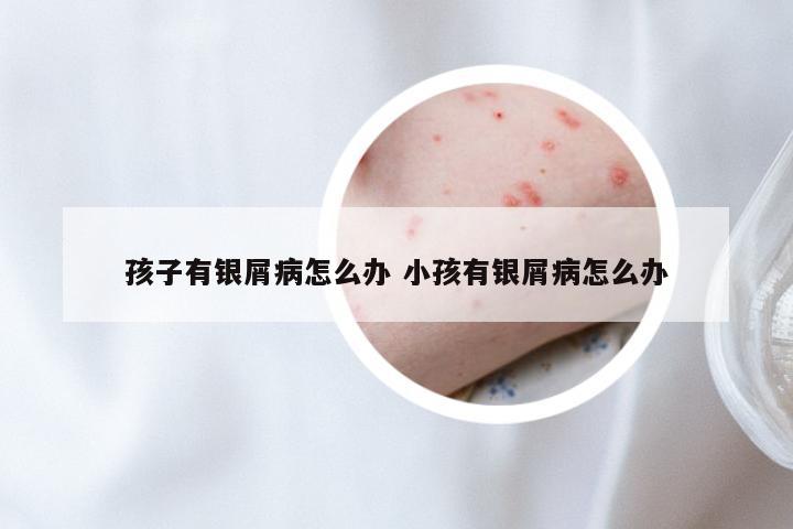 孩子有银屑病怎么办 小孩有银屑病怎么办