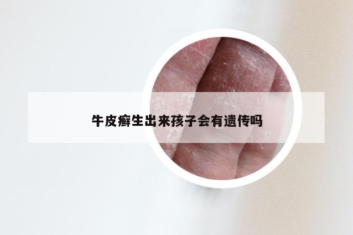 牛皮癣生出来孩子会有遗传吗