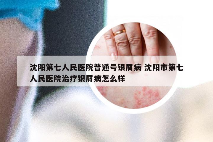 沈阳第七人民医院普通号银屑病 沈阳市第七人民医院治疗银屑病怎么样