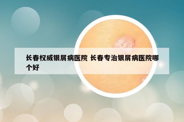 长春权威银屑病医院 长春专治银屑病医院哪个好