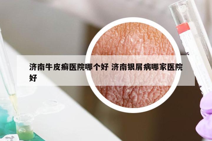 济南牛皮癣医院哪个好 济南银屑病哪家医院好