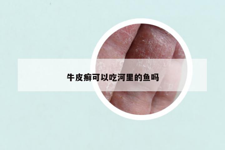牛皮癣可以吃河里的鱼吗