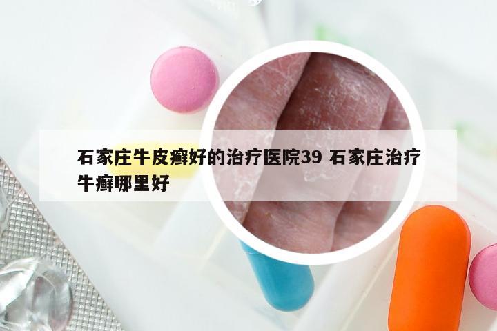 石家庄牛皮癣好的治疗医院39 石家庄治疗牛癣哪里好