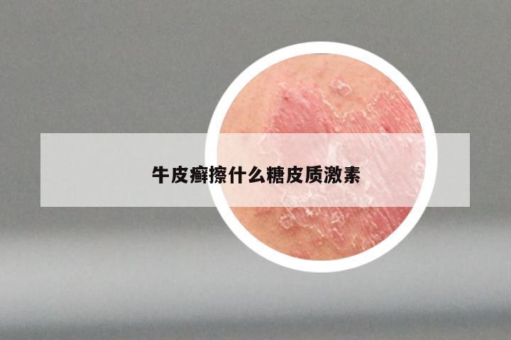 牛皮癣擦什么糖皮质激素