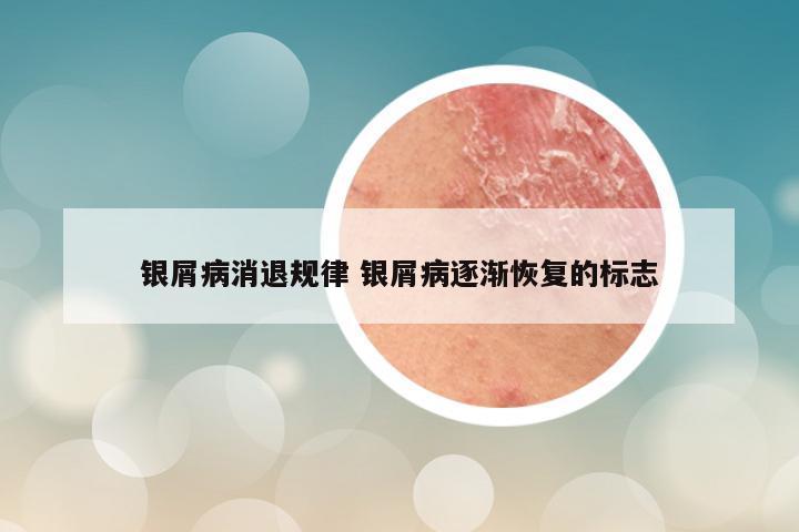 银屑病消退规律 银屑病逐渐恢复的标志