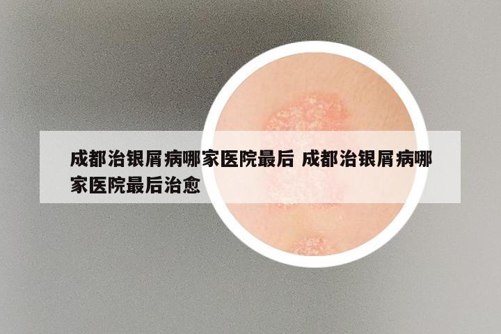 成都治银屑病哪家医院最后 成都治银屑病哪家医院最后治愈