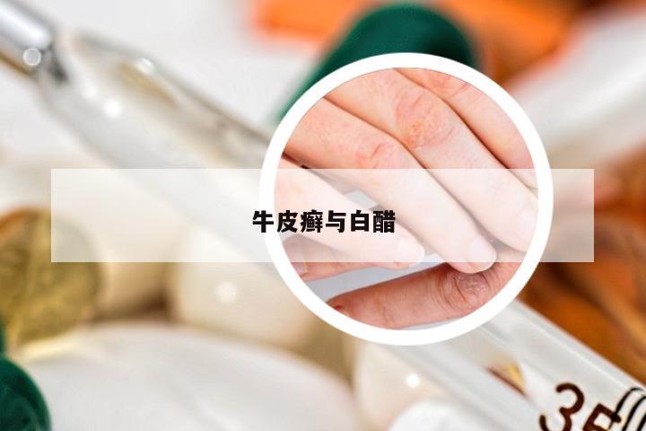牛皮癣与白醋