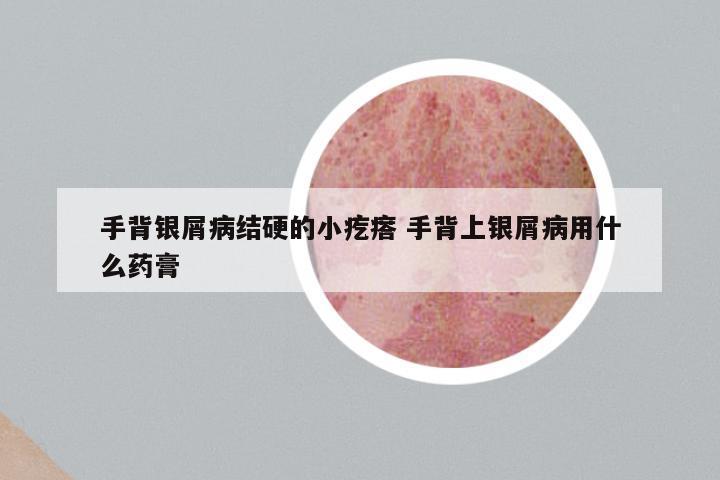 手背银屑病结硬的小疙瘩 手背上银屑病用什么药膏