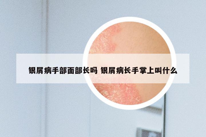 银屑病手部面部长吗 银屑病长手掌上叫什么