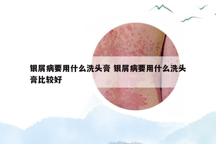 银屑病要用什么洗头膏 银屑病要用什么洗头膏比较好