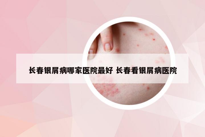 长春银屑病哪家医院最好 长春看银屑病医院