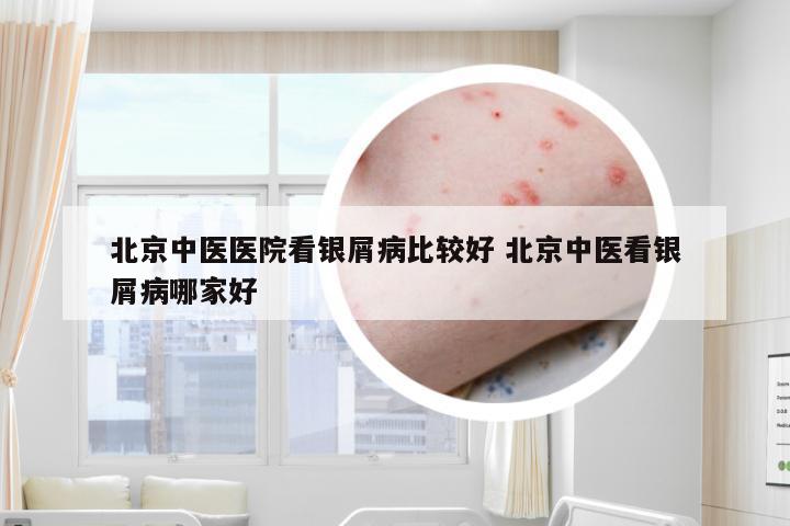 北京中医医院看银屑病比较好 北京中医看银屑病哪家好