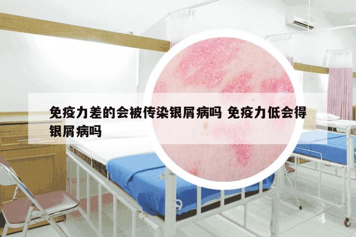 免疫力差的会被传染银屑病吗 免疫力低会得银屑病吗