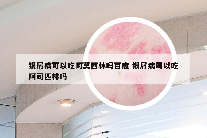银屑病可以吃阿莫西林吗百度 银屑病可以吃阿司匹林吗