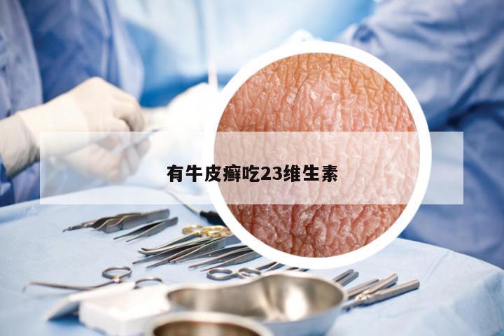 有牛皮癣吃23维生素